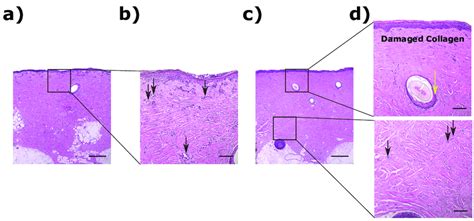 A Shows An Example Of A Superficial Partial Thickness Burn At 5× Download Scientific Diagram