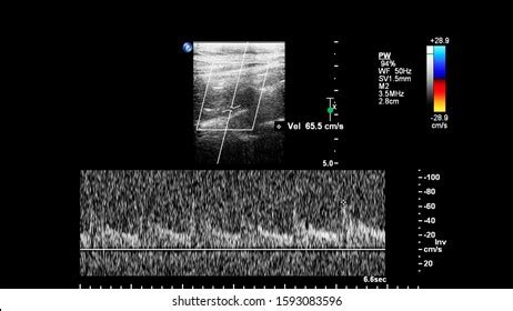 Pulse Wave Doppler Ultrasound Examination Stock Photo 1593083596 | Shutterstock