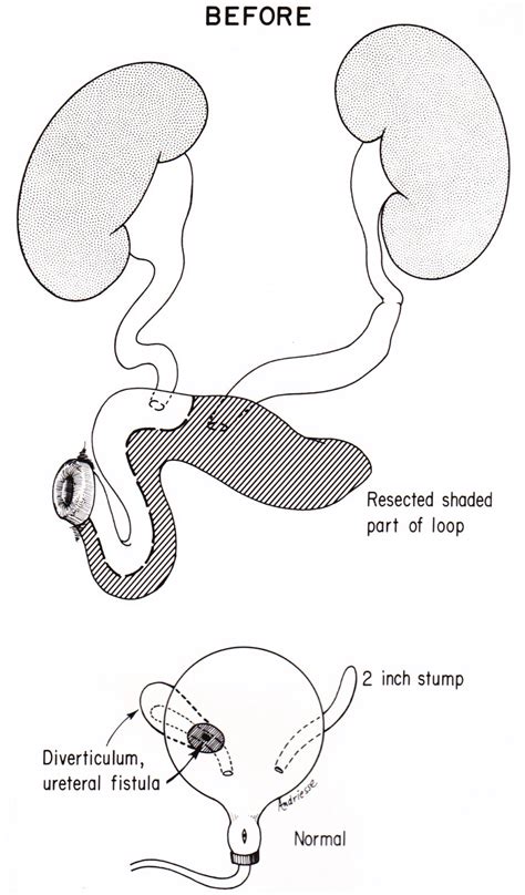 Urinary Tract Reconstruction Patient 5 Undiversion By Removing An