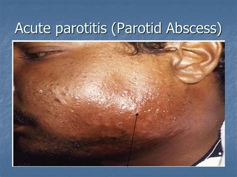 Head And Neck Swellings In Parotid Region Acute Acute Sc Tissue