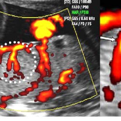 Three Dimensional Planar Power Doppler Ultrasound Image Showing