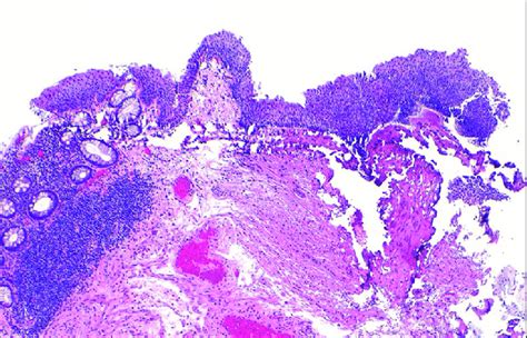 Histopathology Slide Demonstrating Low Grade Intraepithelial Squamous