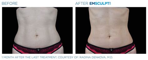 Emsculpt Vs Coolsculpting Non Surgical Body Sculpting Slim Studio