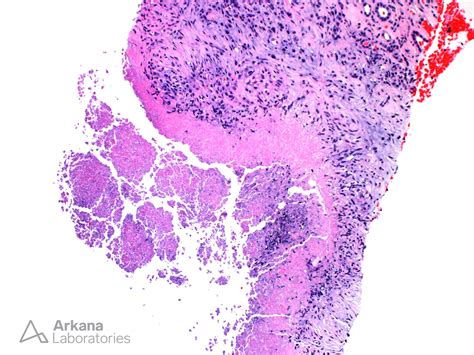 Caseating Granuloma Histology