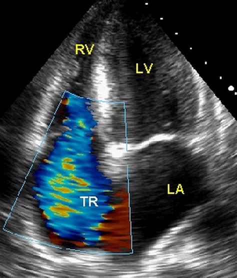 Vegetation On Tricuspid Valve Echocardiographic Image