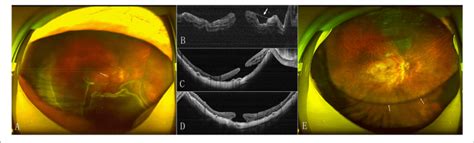 Preoperative And Postoperative Slo And Oct Images Of The Eye Of A