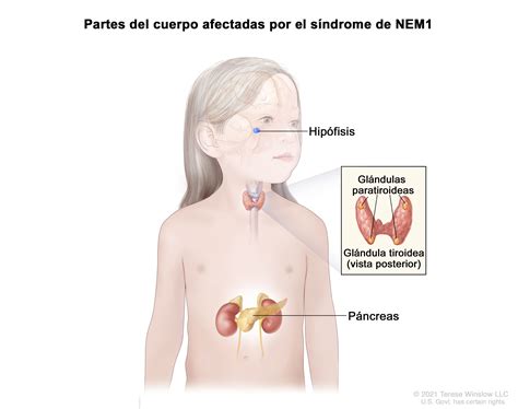 Definici N De S Ndrome De Neoplasia Endocrina M Ltiple Diccionario De