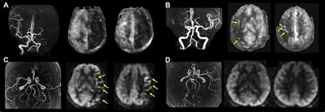 Association Of Fluid Attenuated Inversion Recovery Vascular Hyperintensity With Ischaemic Events