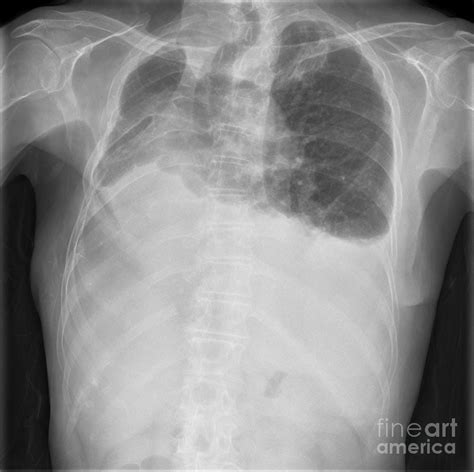 Lung Disease, X-ray Photograph by Science Photo Library - Fine Art America