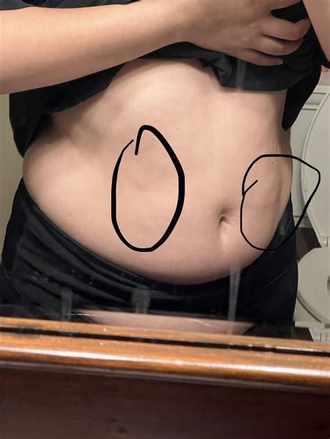 What are these bumps on my stomach? : r/DermatologyQuestions