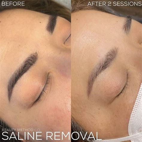 Saline Tattoo Removal Beauty Method Co Brow Tattoo Tattoo Removal