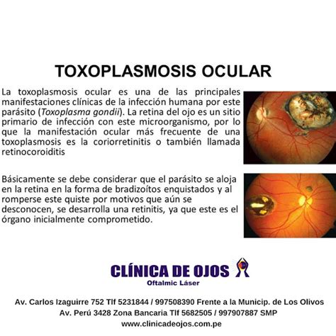 Cl Nica De Ojos Oftalmic L Ser Toxoplasmosis Ocular