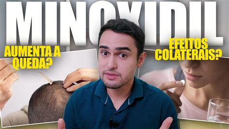 Minoxidil Funciona Existem Efeitos Colaterais Youtube