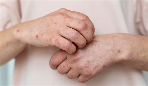 Urticaria Causas Y Tratamientos Antunez Botika