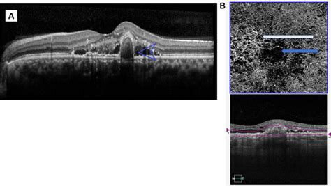 Ss Octa Images Notes A Sd Oct B Scan Showing Double Layer Sign And