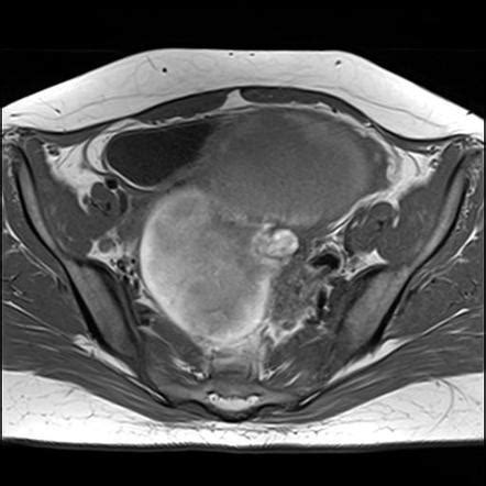 Ovarian Torsion Due To Hemorrhagic Cyst Radiology Case Radiopaedia Org