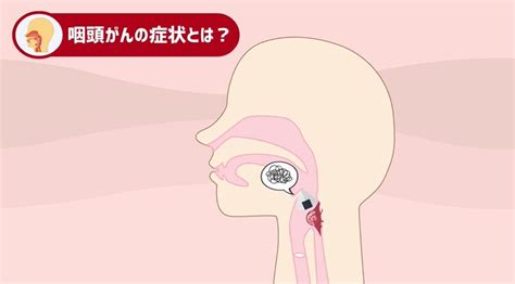 【医師解説】咽頭がん・喉頭がんの初期症状をチェック！原因や治療法は？ ｜medu