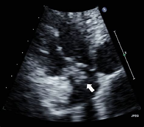 A Vegetation On The Tricuspid Valve Arrow Transthoracic Download Scientific Diagram