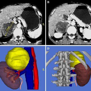 Preoperative Imaging Data Of A Patient With Typical Right Sided Giant