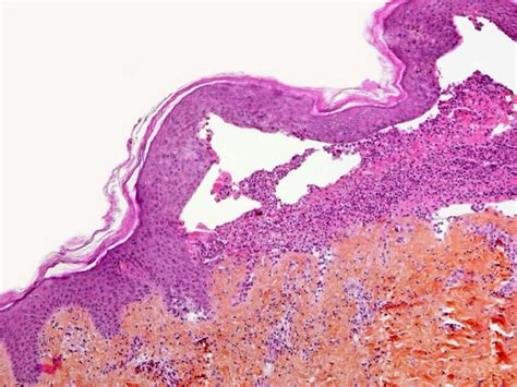 Epidermolysis Bullosa Simplex Histology