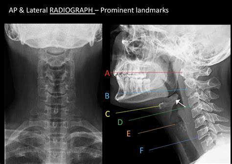 Radiograph Diagram Quizlet