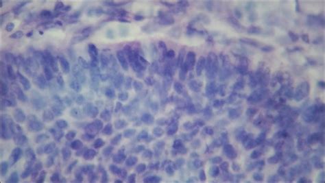 Histological Picture Of Basal Cell Palisading H And E Stain 40×