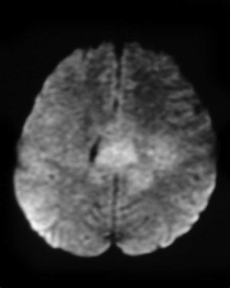 Primary Cns Lymphoma Image Radiopaedia Org