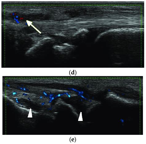 A 34 Year Old Female With Systemic Lupus Erythematosus A