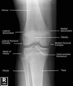 Knee X-rays