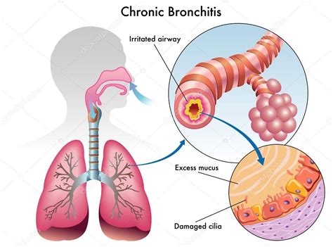 Bronquitis Crónica 2024