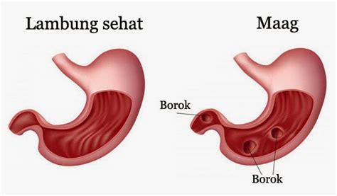 Mengenal Gastritis Maag RS MARDI WALUYO KOTA METRO