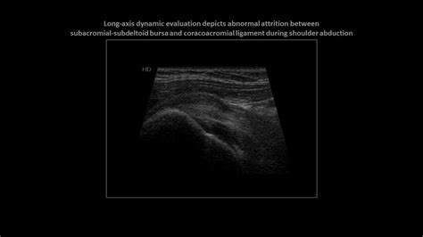 Subacromial Impingement On Dynamic Real Time Shoulder Ultrasound Case