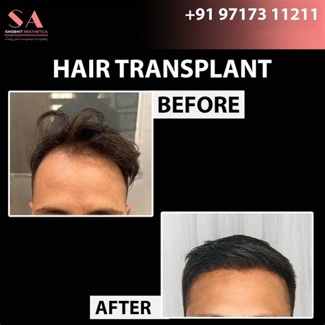 Hair Transplant Clinicsurgeon Cost In Gurgaon Dr Shobhit Gupta