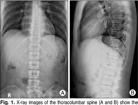 Figure 1 From Spinal Intradural Extramedullary Mature Cystic Teratoma