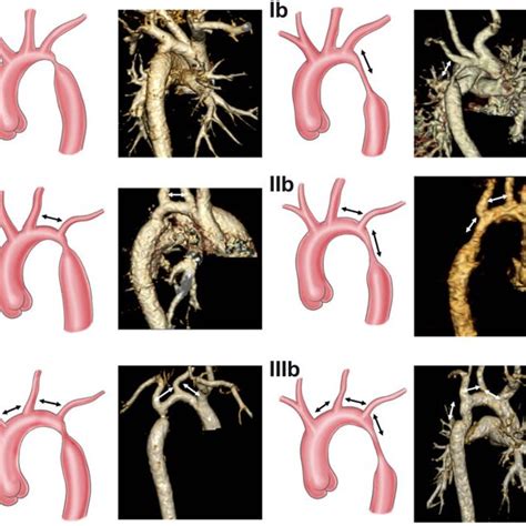 Each Type Of Morphology Of Coarctation Of The Aorta As Shown By Download Scientific Diagram