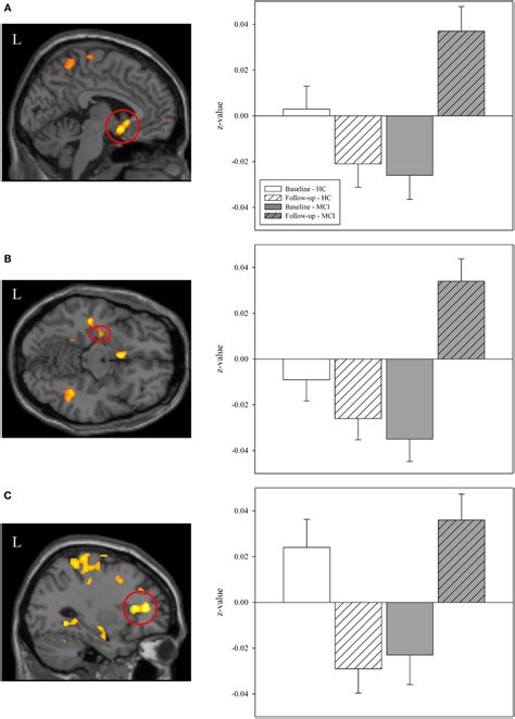 Frontiers Cholinergic Enhancement Of Brain Activation In Mild