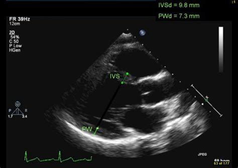 Lv Wall Thickness Echo Normal Iucn Water