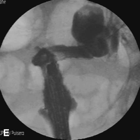 Ultraflex Precision Colonic Stent Placement For Palliation Of Malignant