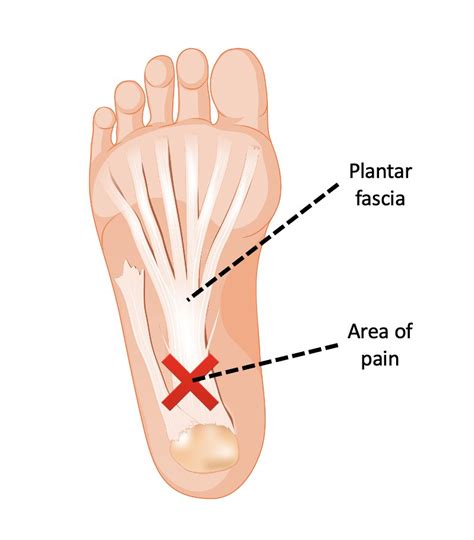 One Of The Worst Injuries You Need To Avoid Plantar Fasciitis Ive