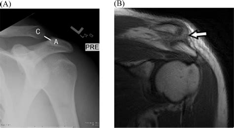 A 24-year-old man with grade 2 acromioclavicular joint separation. (A ...