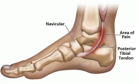 脛後肌炎 Tibialis Posterior Tendonitis 矯形師的心得經驗分享 香港足脊