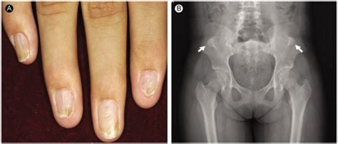 Nail Patella Syndrome Knee