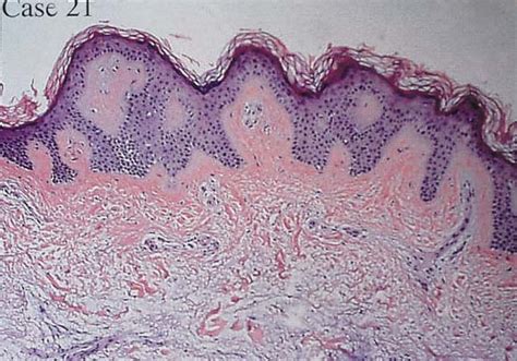 Elephantiasic Pretibial Myxedema A Novel Treatment For An Uncommon Disorder Journal Of The