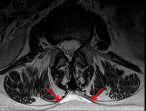 T2 Weighted Tse Mri Axial Image Shows Triangular Form Of Lse In