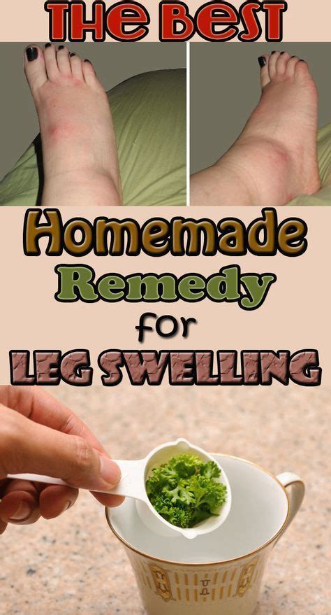 Prevent Leg Swelling And Many Other Diseases With This Amazing Homemade Recipe Swelling