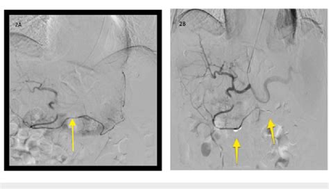 Angiogram Images A Transradial Selective Catheterization And Download Scientific Diagram