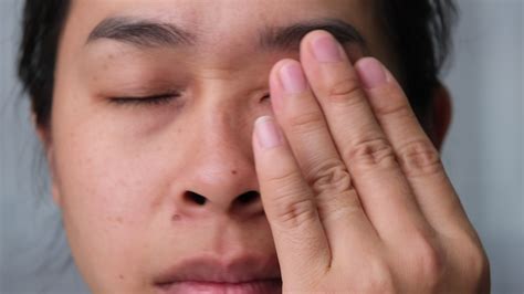 Young Woman Suffering From Eye Pain Allergic To Dust Dry Eyes Watery