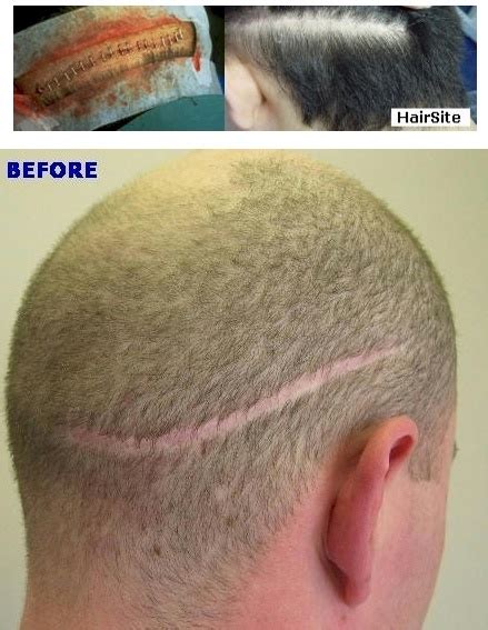 Hair Transplant Strip Scars Repair | HairSite.com