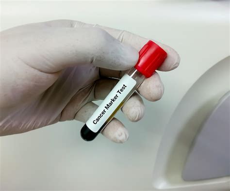 Amostra de sangue para teste de marcador de câncer experiência