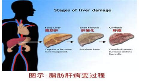 脂肪肝的症状图片脂肪肝图片大全脂肪肝39疾病百科